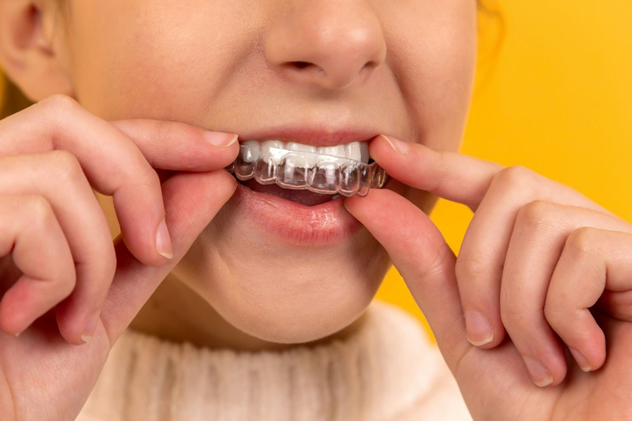 Patient with perfect smile after full arch implants